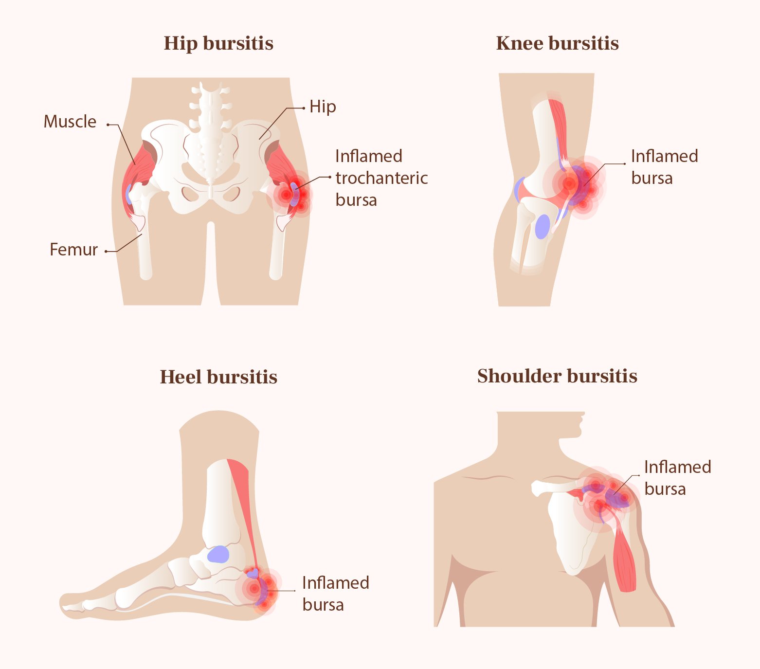 Bursitis - Dr. Helee Khetan | Rheumatologist & Pain Specialist | Gorakhpur