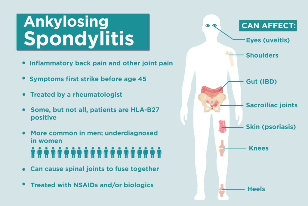 Person experiencing back pain due to ankylosing spondylitis