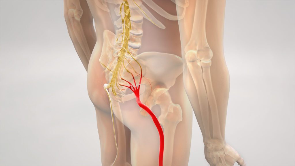 Person experiencing sciatica nerve pain, holding their lower back in discomfort