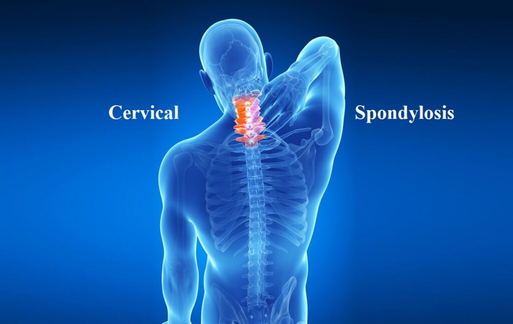 Person experiencing neck pain due to cervical spondylosis.